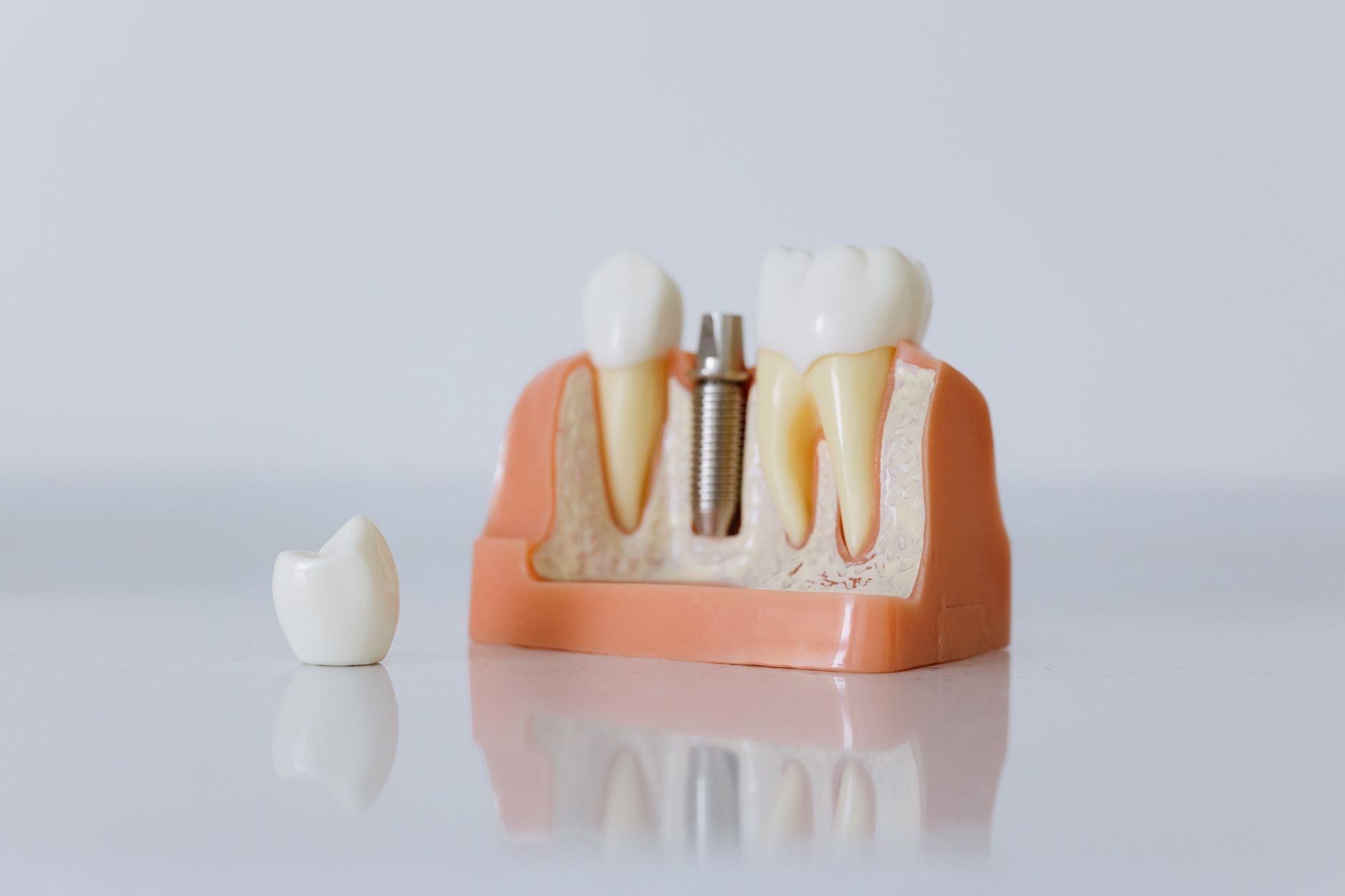 Close-up of a dental implant model showing artificial teeth and jaw structure